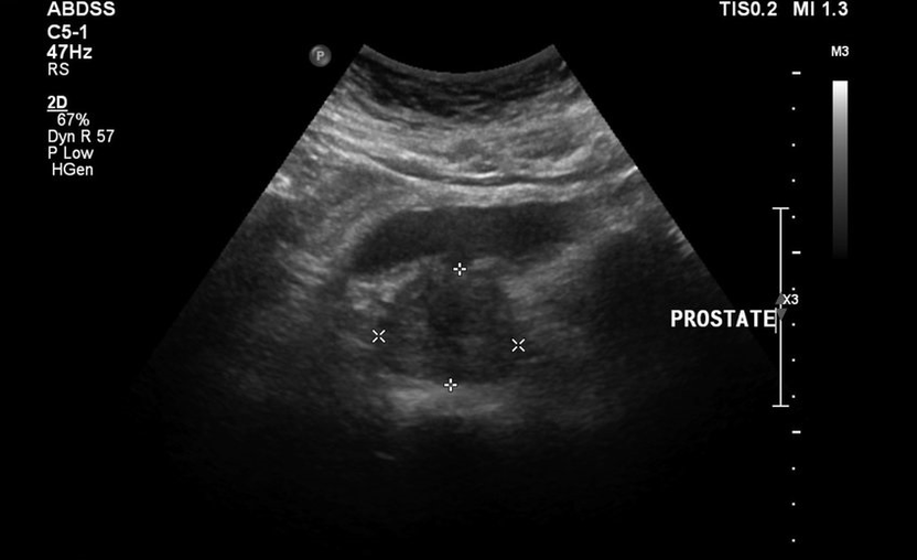 Ultrasound prostatitis before taking ZXCVBNMQ value