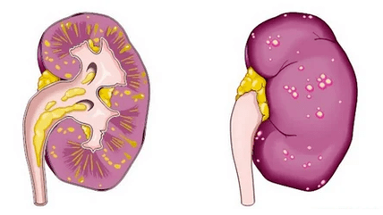 What is acute prostatitis
