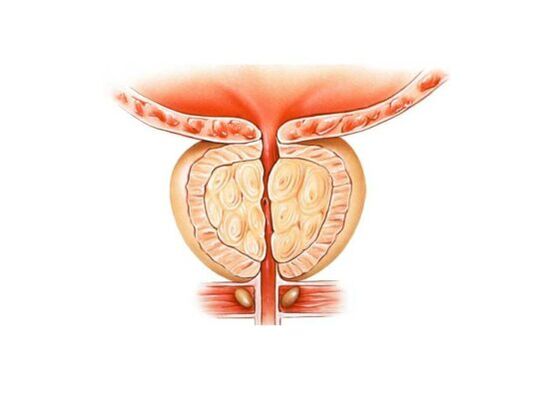 Increased prostate with prostatitis